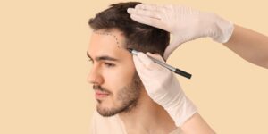 Hair Transplant FUE, Teknologi Modern dengan Masa Pemulihan Lebih Cepat